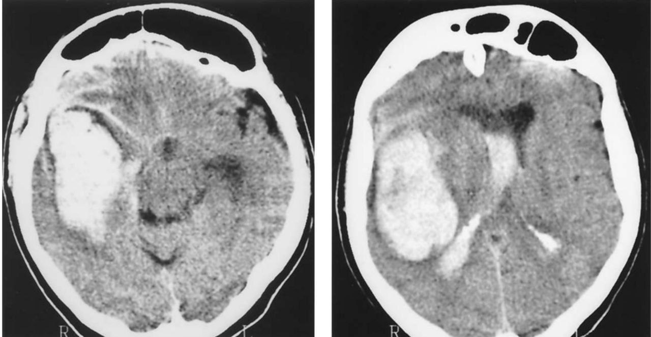 Intracerebral Hemorrhage