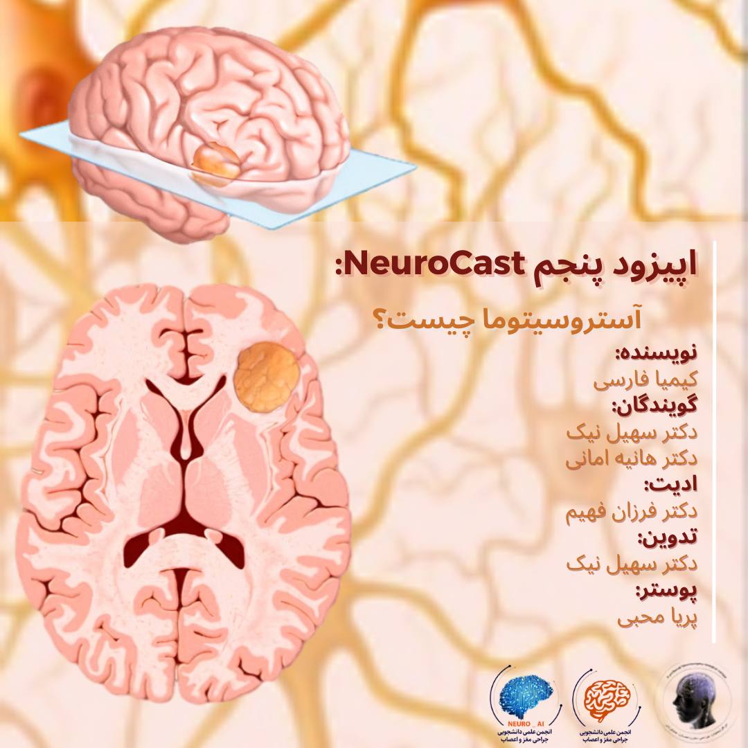 Astrocytoma
