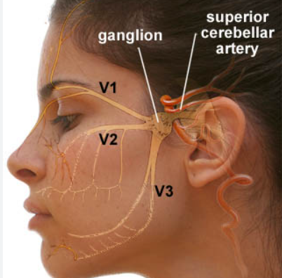 Trigeminal Neuralgia(1)