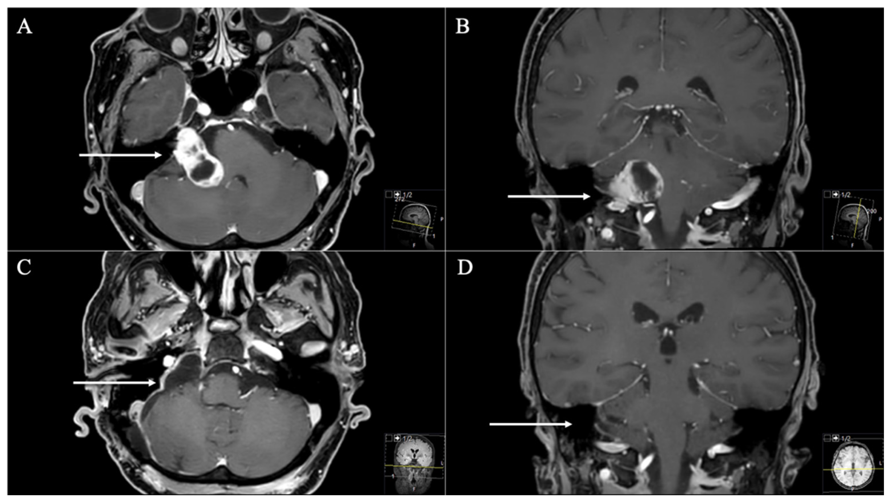 تومورهای فورامن ژوگولار Jugular foramen tumors