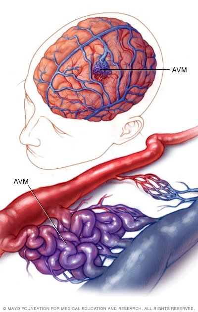 درباره ی AVM Arterio Venous Malformation