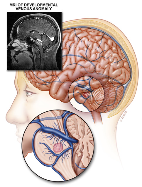 آنومالی مادرزادی وریدی دستگاه عصبی Develompental Venous Anomaly
