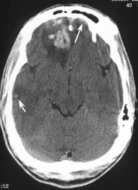 له شدگی مغز Brain Contusion